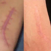 درمان گوشت اضافه  بر اثر سوختگی وچاقو، غیره|خدمات آرایشگری و زیبایی|کوهدشت, |دیوار