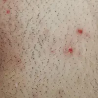 درمان زیگیل تناسلی HPV|خدمات آرایشگری و زیبایی|تهران, جردن|دیوار