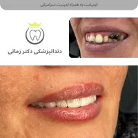 تخفیف ویژه جرمگیری و بلیچینگ (سفید کردن دندان)|خدمات آرایشگری و زیبایی|تهران, امیریه|دیوار