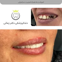 تخفیف ویژه جرمگیری و بلیچینگ (سفید کردن دندان)|خدمات آرایشگری و زیبایی|تهران, امیریه|دیوار