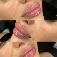 تزریق ژل لب صورت فیلر بوتاکس میکرونیلدینگ مزوتراپی|خدمات آرایشگری و زیبایی|شیراز, شهرک گلستان|دیوار