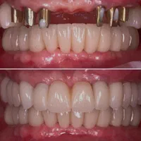 دندانپزشکی ایمپلنت اوردنچر روکش  تخصصی شمال غرب|خدمات آرایشگری و زیبایی|تبریز, |دیوار