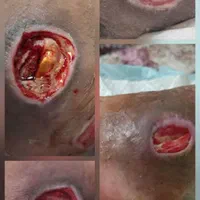 ترمیم زخم دیابتی