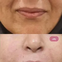 بوتاکس، ژل، چربی، لیزر، هایفوتراپی توسط پزشک|خدمات آرایشگری و زیبایی|یزد, |دیوار