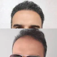 جشنواره کاشت مو وابرو ریحانا|خدمات آرایشگری و زیبایی|کرج, گوهردشت|دیوار