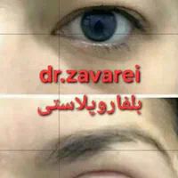 بلفاروپلاستی پلک فوقانی  بالیزر|خدمات آرایشگری و زیبایی|تهران, شهرک غرب|دیوار