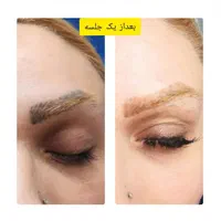 لیزر پاک کردن تاتو کیوسوییچ هایفوفرکشنالco2|خدمات آرایشگری و زیبایی|اهواز, کیانپارس |دیوار