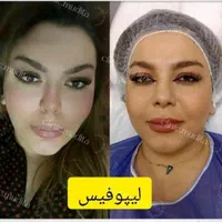 بوکالفت/ساکشن غبغب/ساکشن شکم/تزریق چربی باسن/فیلر|خدمات آرایشگری و زیبایی|تهران, صادقیه|دیوار