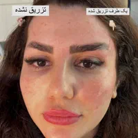 تزریق فیلر صورت مطابق المانهای زیبایی شناسی|خدمات آرایشگری و زیبایی|ورامین, |دیوار