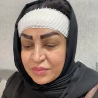 مدل کاشت مو و ابرو تضمینی جهت تولید محتوا|خدمات آرایشگری و زیبایی|شهریار, شهریار|دیوار