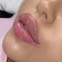 تزریق ژل(دنبی،نورامیس،روفیل)لیفت لیزر هایفو|خدمات آرایشگری و زیبایی|تهران, صادقیه|دیوار