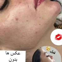 آموزش و انجام خدمات زیبایی ژل، بوتاکس ، آنزیم.مزو|خدمات آرایشگری و زیبایی|بروجرد, |دیوار