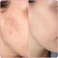 نیازمند مدل پاکسازی فقد هزینه متریال گرفته میشه|خدمات آرایشگری و زیبایی|امیدیه, |دیوار