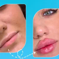 ژل لب/بوتاکس /فیلر بادی
