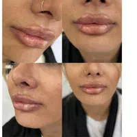 تزریق ژل و بوتاکس تمام ایام حتی روزهای تعطیل|خدمات آرایشگری و زیبایی|فردیس, |دیوار
