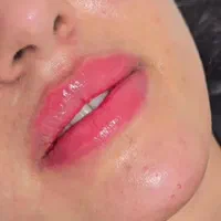 ژل وبوتاکس404(اقساط)(توسط پزشک)