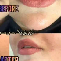 آموزش تخصصی فیلر و بوتاکس خدمات زیبایی|خدمات آموزشی|مشهد, هنرستان|دیوار