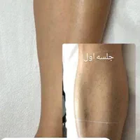 لیزر جدیدترین تیتانیوم۲۰۲۵باضمانت نامه۵۰درصد تخفیف