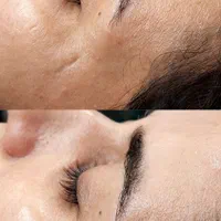 پاکسازی فیشال مزونیدلینگ اسکالپ کربوکسی پلکسر|خدمات آرایشگری و زیبایی|مشهد, رسالت|دیوار
