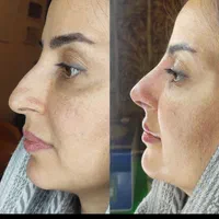 لیفت بینی بانخ|خدمات آرایشگری و زیبایی|تبریز, |دیوار