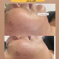 لیزر co2 فراکشنال و هایفوی پزشکی نه رومیزی|خدمات آرایشگری و زیبایی|اهواز, کیانپارس |دیوار