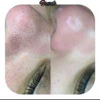 پاکسازی و فیشیال پوست|خدمات آرایشگری و زیبایی|یاسوج, |دیوار