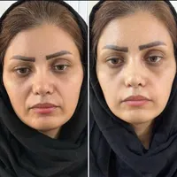 تخفیف بوتاکس، فیلر، بلفاروپلاستی، لاغری و فیشال|خدمات آرایشگری و زیبایی|تهران, ظفر|دیوار