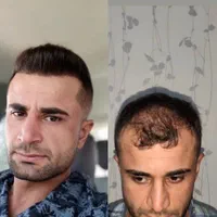 کاشت مو ابرو ریش تارکوب|خدمات آرایشگری و زیبایی|ساوه, |دیوار