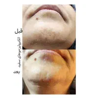 پوست صاف ویکدست میخوای متن آگهی روبخون+پیشنهادویژه|خدمات آرایشگری و زیبایی|قم, باجک دو|دیوار