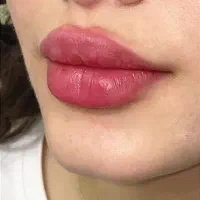 ژل لب چانه گونه بوتاکس فیلرآنزیم بینی لیزرهایفو|خدمات آرایشگری و زیبایی|مشهد, سجاد شهر|دیوار