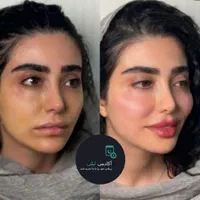 بوتاکس ژل لب زاویه فک.گونه .چانه. پرکردن صورت لاغر|خدمات آرایشگری و زیبایی|قم, زنبیل آباد|دیوار