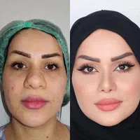 عمل جراحی زیبایی بینی ۲۴ میلیون  رینو بلفارو لیپو|خدمات آرایشگری و زیبایی|تهران, میدان ولیعصر|دیوار