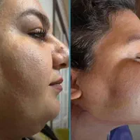 مرکزلیپوساکشن‌ و ساکشن غبغب و زاویه سازی توسط جراح|خدمات آرایشگری و زیبایی|مشهد, سناباد|دیوار