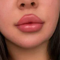 کلینیک پوست و زیبایی ژل لب/فیلرگونه/زاویه/بوتاکس|خدمات آرایشگری و زیبایی|قم, صفائیه|دیوار