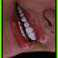 کامپوزیت دندان/دندانپزشکی/ترمیم/عصبکشی/لمینیت|خدمات آرایشگری و زیبایی|تهران, تهرانپارس شرقی|دیوار