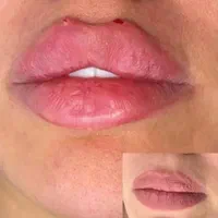 تزریق ژل فیلر بوتاکس مزوژل|خدمات آرایشگری و زیبایی|مشهد, طبرسی شمالی|دیوار