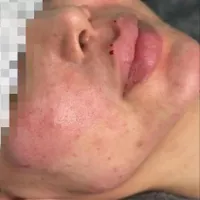 تزریق ژل بوتاکس و خدمات زیبایی پوست مو