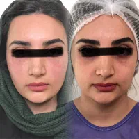 تزریق چربی صورت دست با سن بیکینی در کلینیک تخصصی|خدمات آرایشگری و زیبایی|تهران, صادقیه|دیوار
