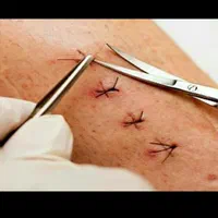 بخیه و تزریقات سرم تراپی و پانسمان در منزل