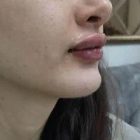 تزریق بوتاکس و ژل در کلینیک(توسط پزشک،)|خدمات آرایشگری و زیبایی|مشهد, هفت تیر (آب و برق)|دیوار