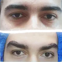 بلفاروپلاستی/ جراحی پلک / لیفت ابرو/ سانترال لب|خدمات آرایشگری و زیبایی|تهران, صادقیه|دیوار