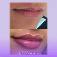 تزریق ژل بوتاکس لیزرمو مزو فیلرلب روسی لیفت صورت|خدمات آرایشگری و زیبایی|تهران, پونک|دیوار