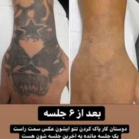 مرکز ریمو،پاک کردن،ریموو تتوابرو.بدن.خط چشم بالیزر|خدمات آرایشگری و زیبایی|شیراز, فرهنگ شهر|دیوار