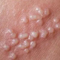 درمان زگیل،تبخال تناسلی خانمهاو آقایان،درمطب متخصص|خدمات آرایشگری و زیبایی|تبریز, |دیوار