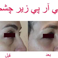 (پی آر پی بدون درد) رشد مجدد مو ،  جوانسازی صورت|خدمات آرایشگری و زیبایی|اهواز, زیتون کارمندی|دیوار