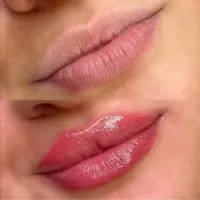 مطب پزشک ژل و بوتاکس ژل لب گونه چونه فیلر بینی|خدمات آرایشگری و زیبایی|قم, صفائیه|دیوار