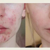 جوش و تیرگی صورت ، ریزش مو ، جوانسازی پوست|خدمات آرایشگری و زیبایی|رفسنجان, |دیوار