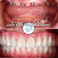 دندانپزشکی تخصصی ایمپلنت پیوند استخوان /اقساط|خدمات آرایشگری و زیبایی|تهران, پونک|دیوار