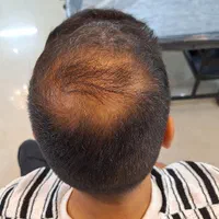 پرپشتی مو با روش اسکالپ/میکرواسکالپ در کلینیک پزشک|خدمات آرایشگری و زیبایی|مشهد, احمدآباد|دیوار