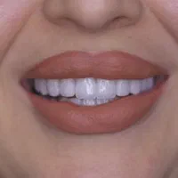 کامپوزیت دندان لمینیت بلیچینگ ایمپلنت روکش دندان